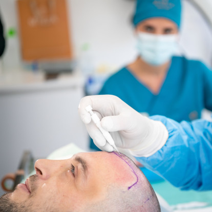 Η κλινική μεταμόσχευσης μαλλιών στην καρδιά της Θεσσαλονίκης που εφαρμόζει μια από τις πλέον καινοτόμες τεχνικές παγκοσμίως